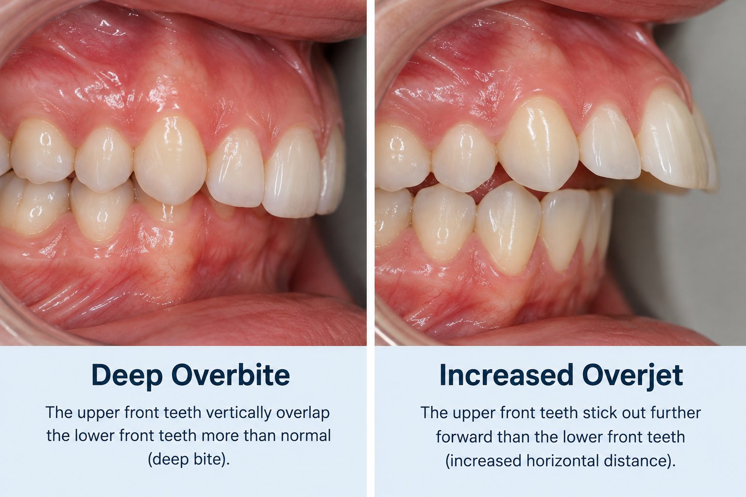 Two side-by-side profile views of front teeth: on the left the upper teeth overlap the lower teeth vertically; on the right the upper teeth project horizontally ahead of the lower teeth.