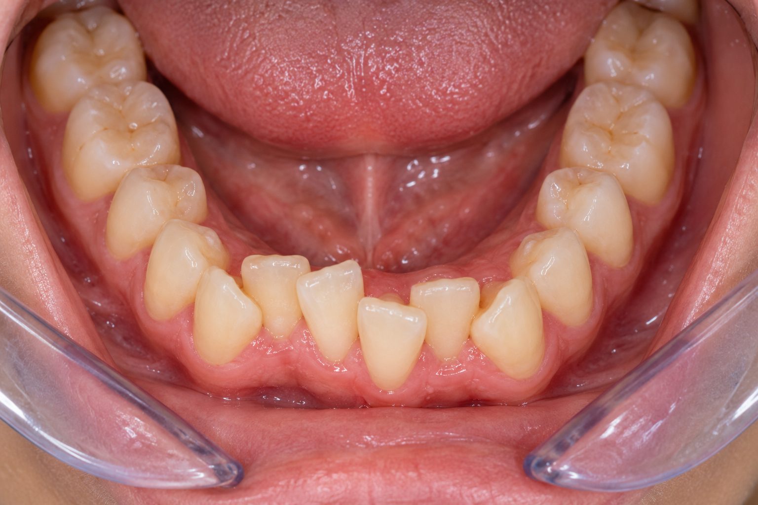 Looking down onto a lower arch with a cheek retractor in place: the four front teeth overlap and two are rotated.