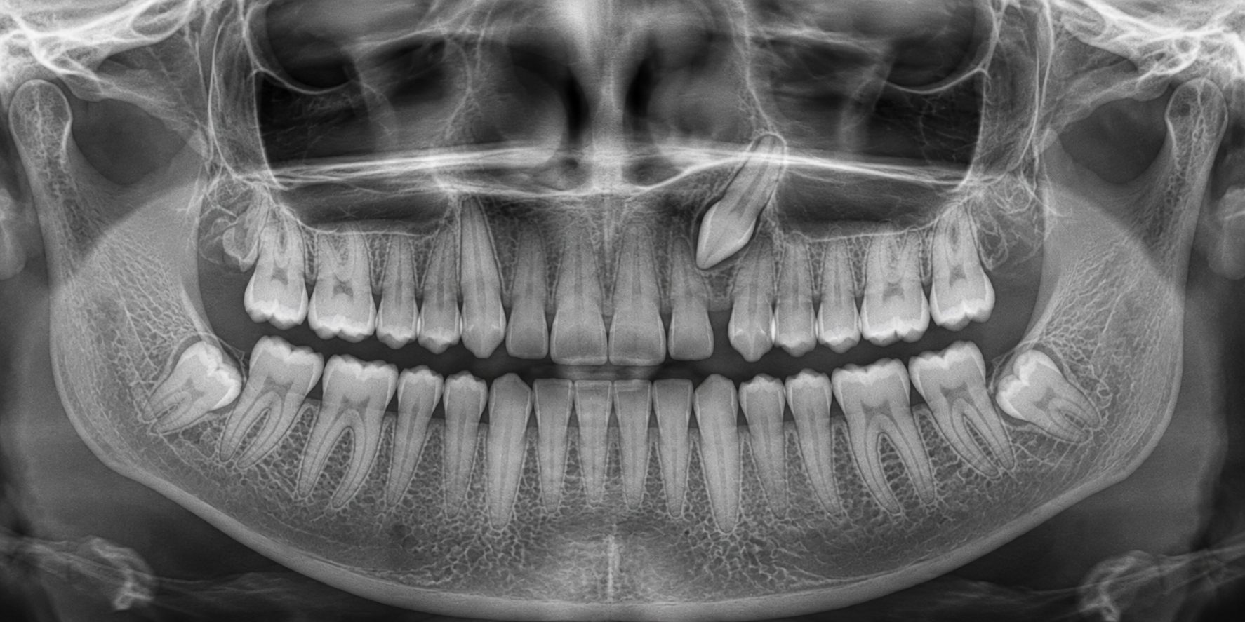 Illustration of a panoramic dental radiograph with one upper canine lying high and tilted across the roots of the neighbouring teeth instead of erupting.