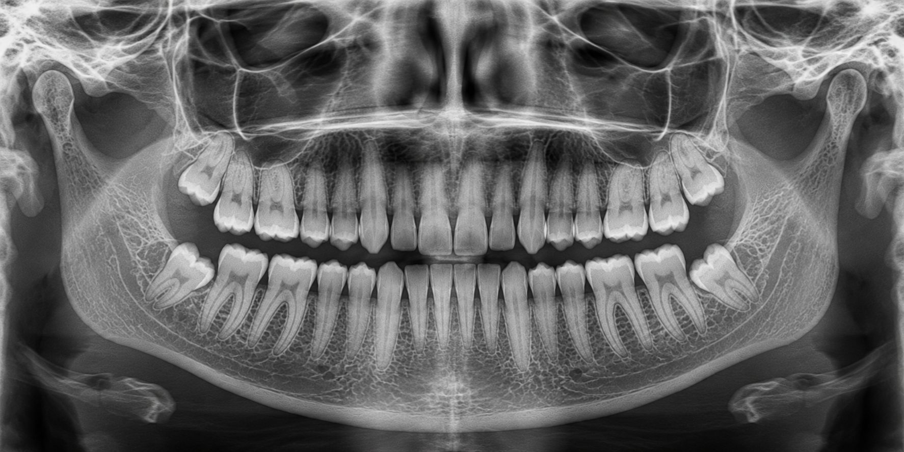 Illustration of a panoramic dental radiograph showing all four wisdom teeth still in the bone behind the second molars.