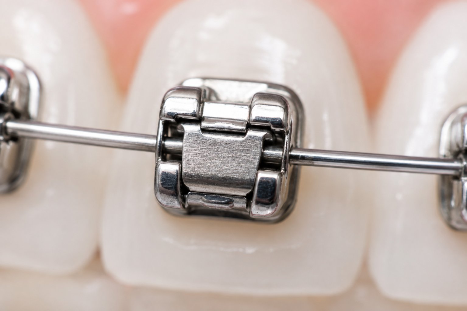 Close-up of a self-ligating bracket holding the archwire with its built-in clip.